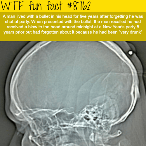 A man lived with a bullet in his head for 5 years - WTF fun facts