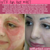 a woman tattoos the burn scars of her face wtf