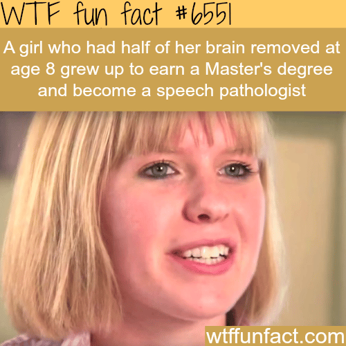 Girl with a half brain gets a Master’s degree - WTF fun facts