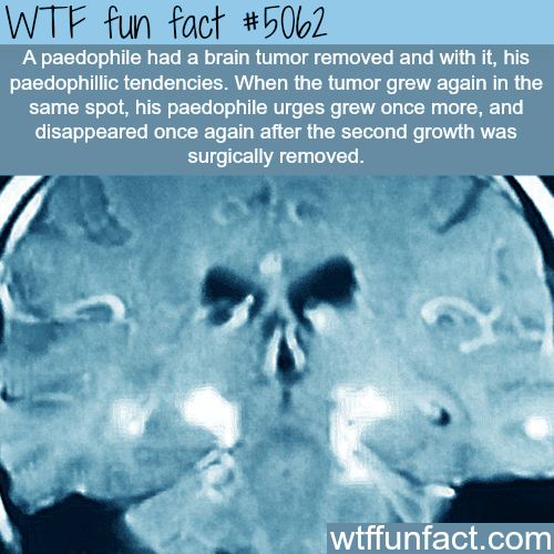 Pedophile loses his urges after brain surgery - WTF fun facts