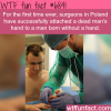 polish surgeon attach a dead mans hand to a man