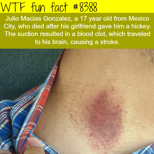 teenager dies because of a hickey wtf fun facts.
