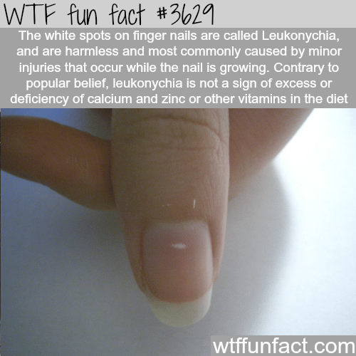 The cause of the white spots on your finger nails -  WTF fun facts