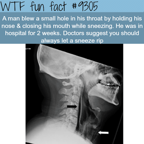 Why you shouldn’t hold your sneeze - WTF Fun Fact