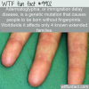 Weird Fact Born without fingerprints