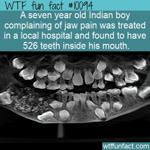 WTF Fun Fact - Boy With 526 Teeth
