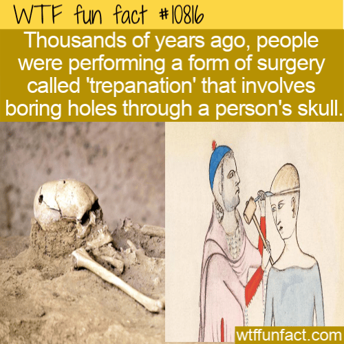 WTF Fun Fact - skull Hole Surgery