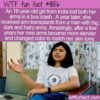 WTF Fun Fact – Unusual Arm Transplant Behavior