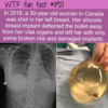 WTF Fun Fact – Breast Implant Deflects Bullet