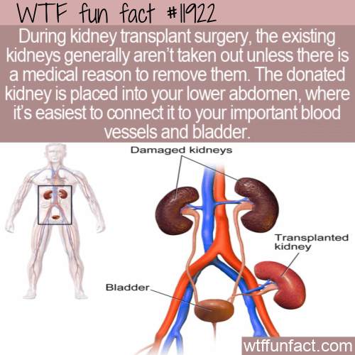 WTF Fun Fact - Three Kidneys After A Transplant